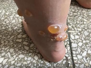 什么虫子咬了会起水泡_被虫子咬后水泡怎么处理