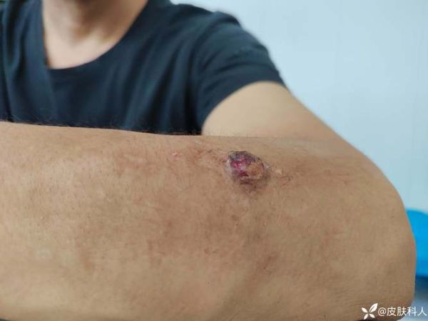 烂皮是什么_烂皮怎么治疗