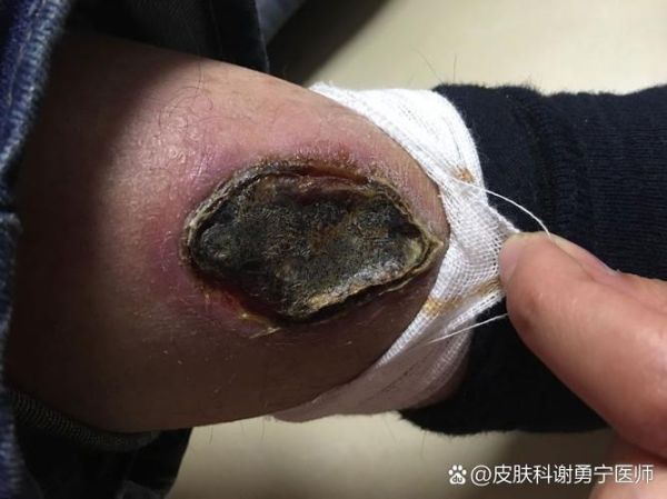 烂皮是什么_烂皮怎么治疗