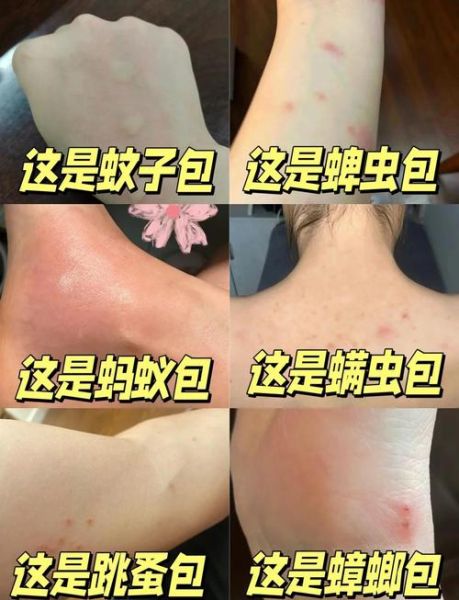什么虫子会咬人_被虫子咬了怎么办