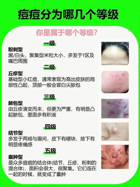 脸上长痘痘是什么原因_脸上长痘痘怎么快速消除