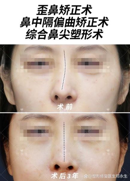 鼻子歪了怎么办_歪鼻矫正多少钱