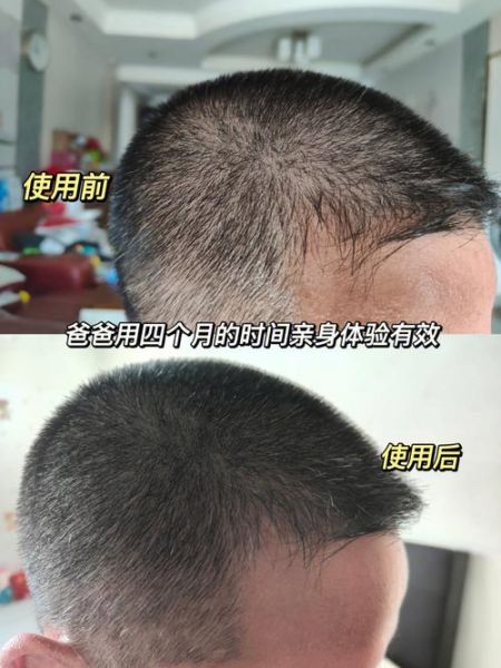 秃顶怎么治_秃顶用什么药