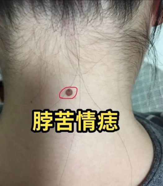 苦情痣男财运_苦情痣男人会穷吗
