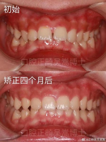 龅牙会影响财运吗_龅牙与面相财运关系