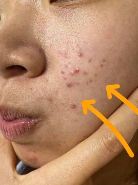 痤疮运势_痤疮会影响运势吗