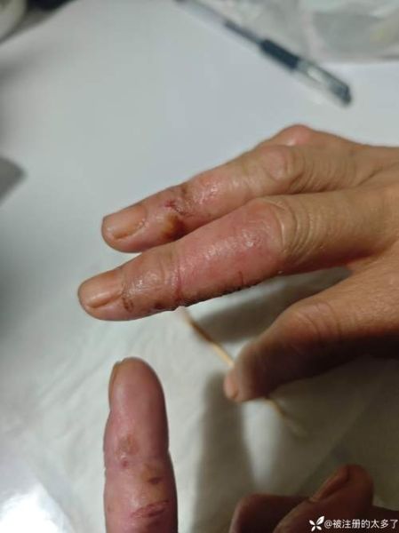 梦到手溃烂_梦见手烂掉代表什么