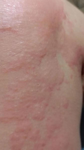 梦到起红疹是什么意思_梦到起红疹预示着什么