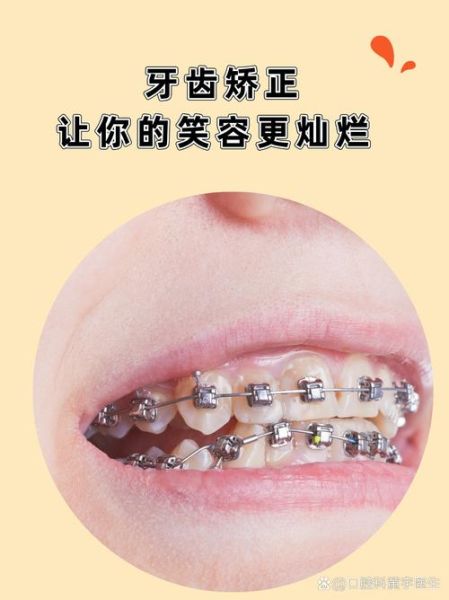 牙齿矫正会影响财运吗_牙齿矫正后财运会变好吗