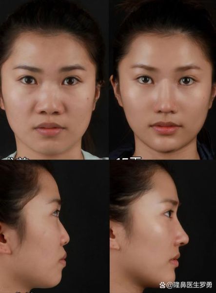 鼻子窄没财运是真的吗_面相鼻子窄如何改运