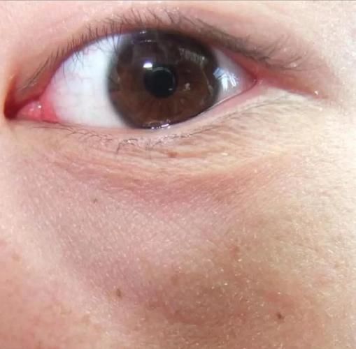 肿眼泡运势_肿眼泡面相命运解析