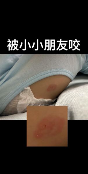 梦到被小孩咬是什么意思_如何化解
