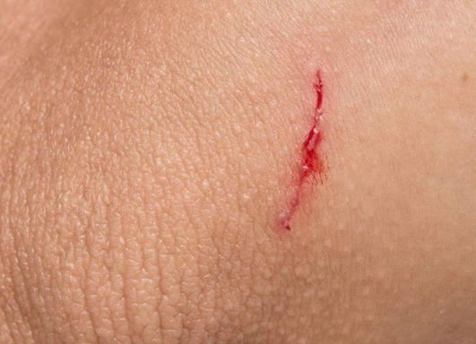 梦到胳膊受伤流血_是什么意思