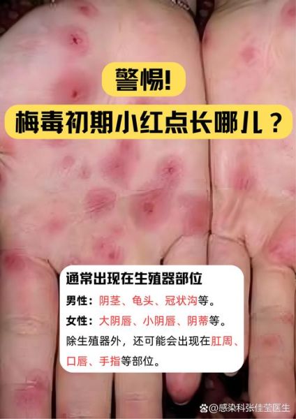 梦到梅毒是什么意思_梦到梅毒预示什么