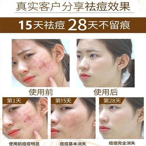 梦到脸长痘是什么意思_梦见脸上长痘痘预示什么