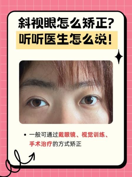 斜视的人运势怎样_斜视会影响命运吗