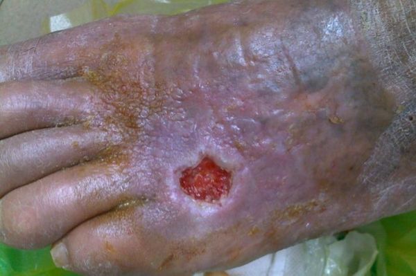 梦到皮肤溃烂_梦见皮肤腐烂预示什么