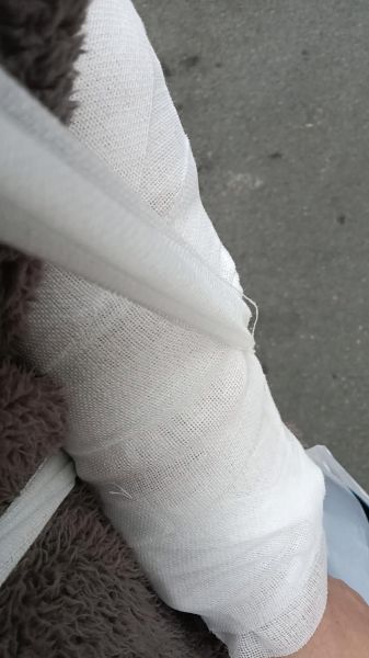 梦到朋友胳膊断了_是什么预兆