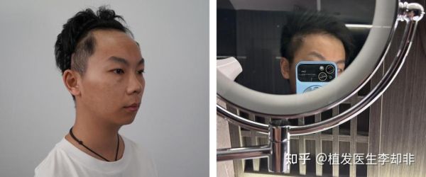 财运发际线后移怎么办_发际线高影响财运吗