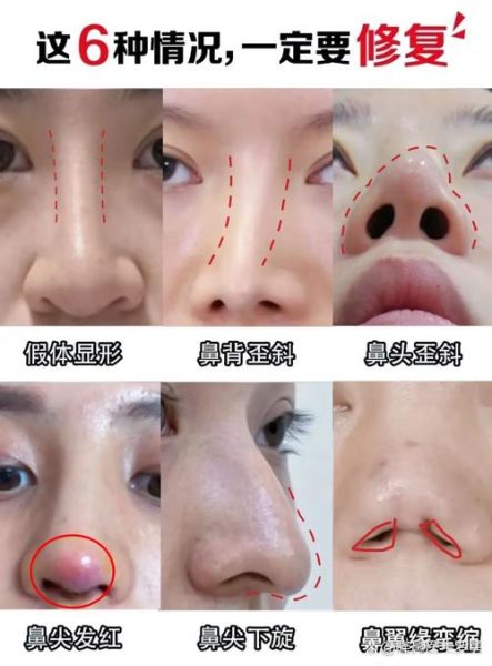 动了鼻子影响财运吗_隆鼻后破财怎么办