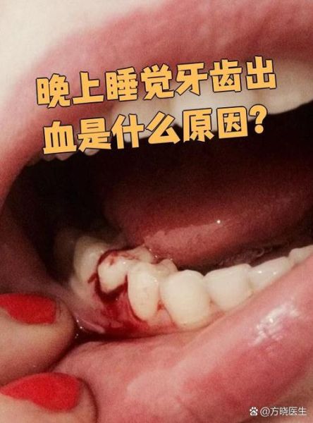 梦到牙齿流血是什么意思_梦到牙齿流血怎么办