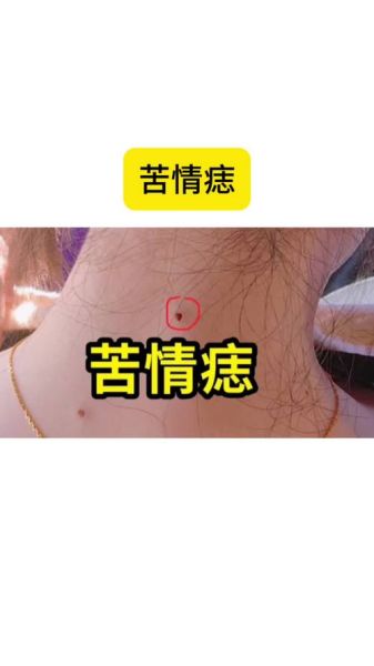 苦情痣会影响财运吗_苦情痣如何改运
