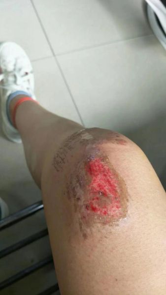 梦到大腿流血_梦见大腿受伤流血是什么意思