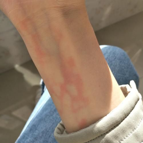 梦到胳膊红_周公解梦胳膊发红预示什么