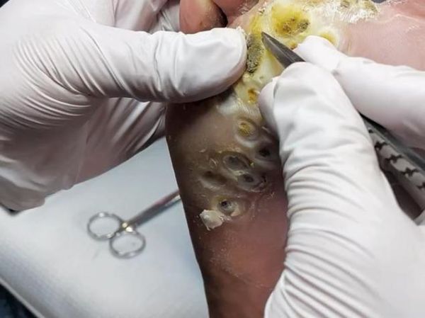 梦到刺扎腿是什么意思_梦见腿被刺扎预示什么