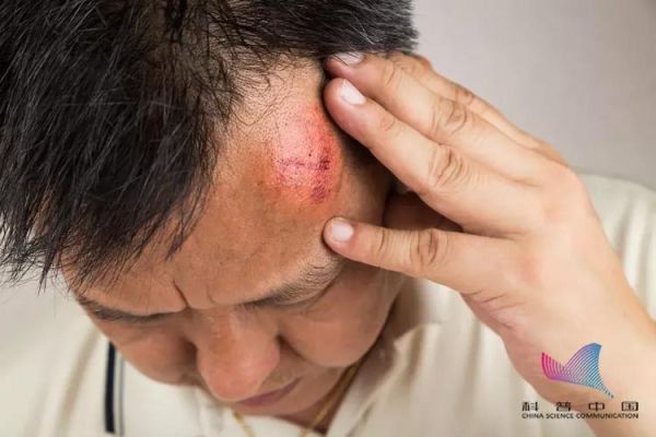 梦到自己受伤出血是什么意思_梦到自己受伤出血怎么办