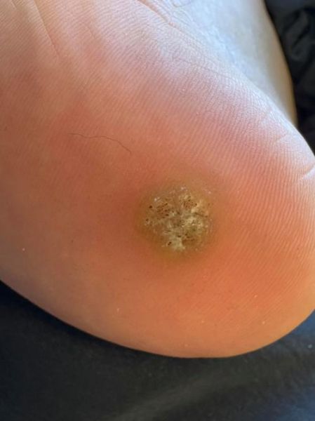 脚底长鸡眼财运_脚底长鸡眼财运好不好