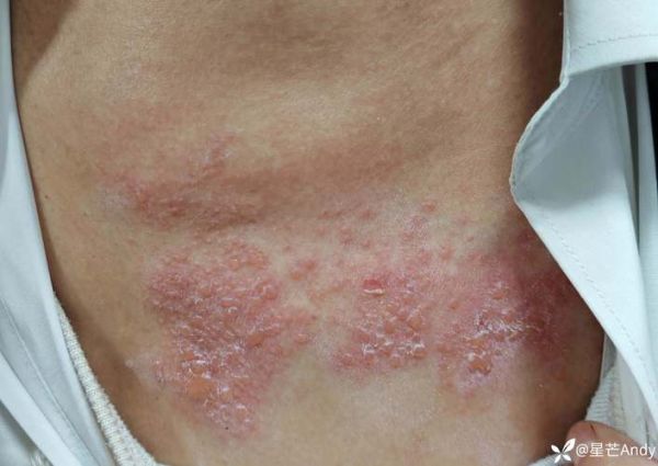 梦见皮肤病是什么意思_梦到皮肤病怎么办