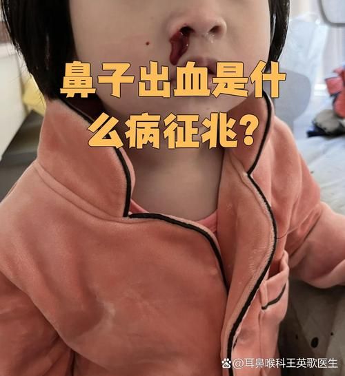 梦到鼻子受伤是什么意思_梦见鼻子流血预示什么