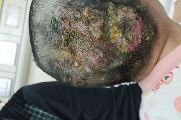 梦见头上长疮_周公解梦