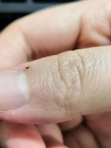 大拇指痣财运_大拇指有痣代表什么财运