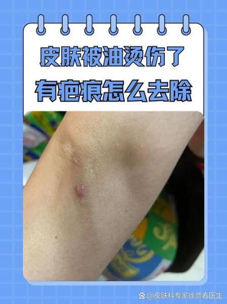 梦到热油是什么意思_梦见热油烫伤预示什么