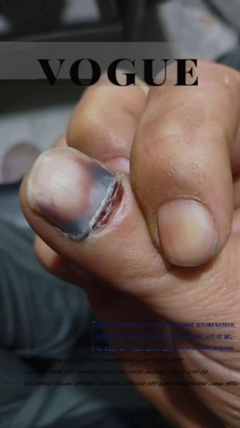 梦到掉指甲盖是什么意思_梦到指甲盖掉了预示什么