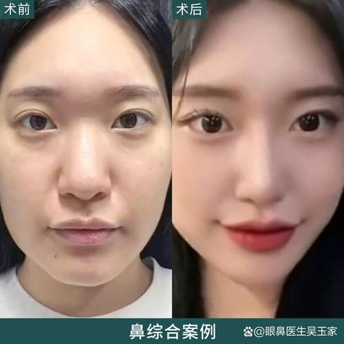 鼻子大整容会破财吗_鼻子大整容后财运会变好吗