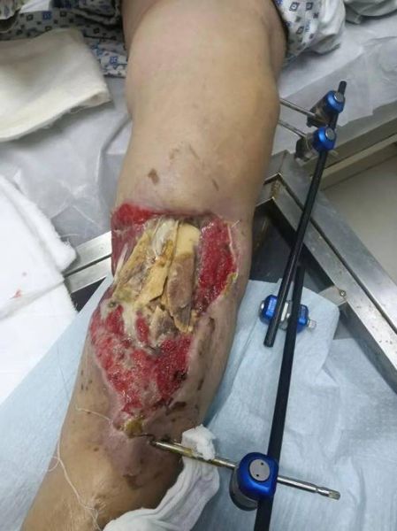 梦到爸爸腿截肢了_意味着什么