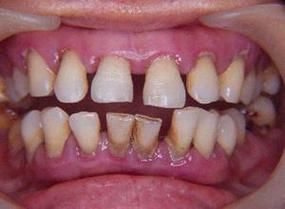 牙缝宽的人财运真的好吗_牙缝宽的人财运如何提升