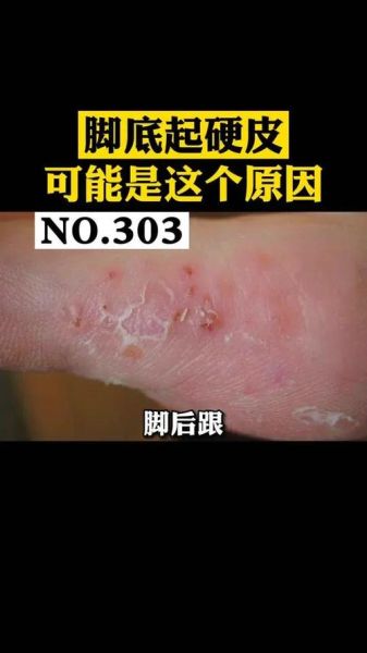 梦到脚底脱皮是什么意思_脚底脱皮梦境解析