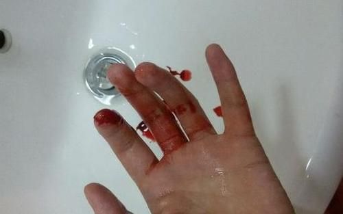 梦到手破了_是什么意思