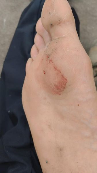 梦到针扎脚是什么意思_梦见脚被针扎预示什么